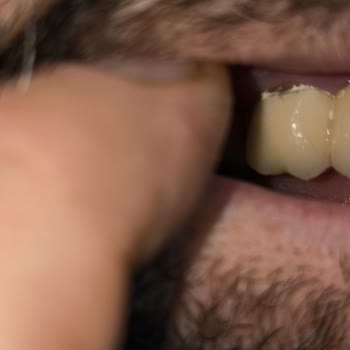 Eskişehir Ağız ve Diş Sağlığı Hastanesi Yapılan Diş Kaplaması