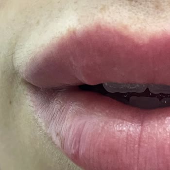 Estetik Land Dudak Dolgusu Zaman İçinde Top Şeklinde Belirtiler Veriyor!