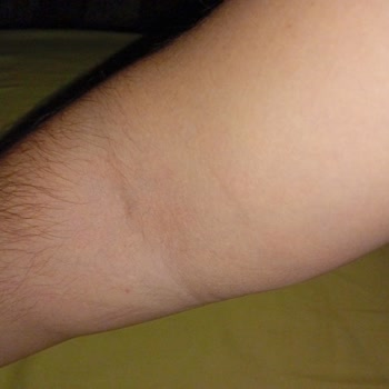 Özel Optimed Hastanesi Serum Takma İşleminde Yaşanan Sorun