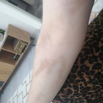 İnayet Topçuoğlu Hastanesi Tedavi Sonrası Kalıcı Rahatsızlık