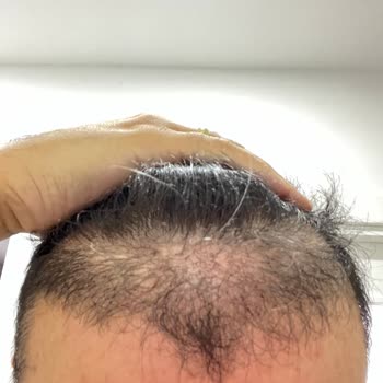 Estecenter Faciası ve Korkunç Saç Ekimi