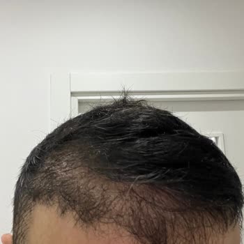 Estecenter Faciası ve Korkunç Saç Ekimi