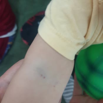Medipol Sağlık Grubu Damar Yolu Açılamadı, Para İadesi Yapılmadı, Kötü Muamele Gördük.