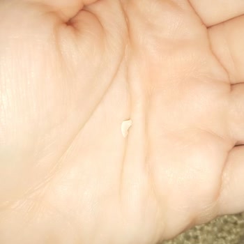 Dürümle Dürümden Çıkan Kemik Dişimi Kırdı
