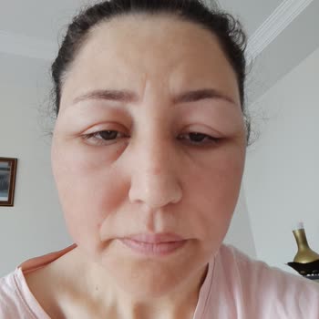 The Purest Solutions Ücretsiz Ürün Alerji Yaptı!
