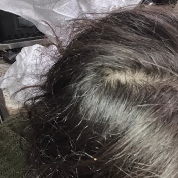 Kronos Kuaför Saçlarımı Kopararak Bölgesel Kellik Yarattı