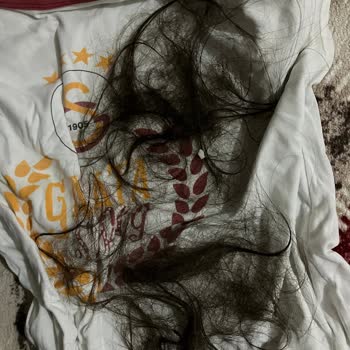 Kronos Kuaför Saçlarımı Kopararak Bölgesel Kellik Yarattı