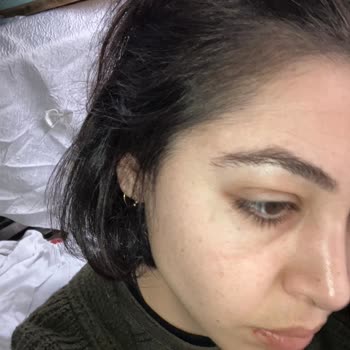 Kronos Kuaför Saçlarımı Kopararak Bölgesel Kellik Yarattı