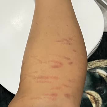 Aris Çukurambar Vip Çukurambar Güzellik Merkezinde Yaşanan Sağlık Sorunları