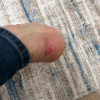 Vaneda Topuk Kısmında Yara Olması Halinde İade Olmaması