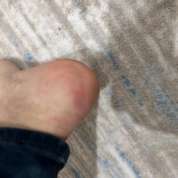 Vaneda Topuk Kısmında Yara Olması Halinde İade Olmaması