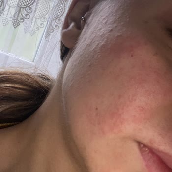 S'he Vec. Toniğin Yüzümü Mahvetmesi