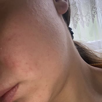 S'he Vec. Toniğin Yüzümü Mahvetmesi