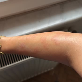 As Estetik (İstanbul) Lazerde Kolumu Yaktılar