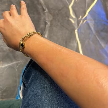 As Estetik (İstanbul) Lazerde Kolumu Yaktılar