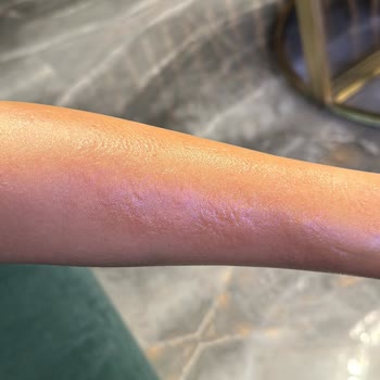 As Estetik (İstanbul) Lazerde Kolumu Yaktılar