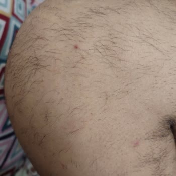 Suit Güzellik Merkezleri Lazer Epilasyon Kıl Dökülmesi