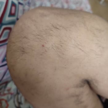 Suit Güzellik Merkezleri Lazer Epilasyon Kıl Dökülmesi