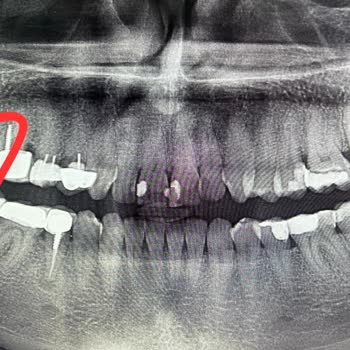 Dent Araz'da Çok Kötü Dolgu Yaptılar