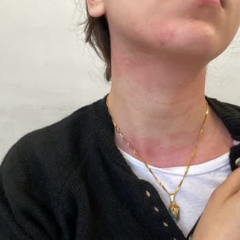 ABC Yumuşatıcı Alerjik Reaksiyon