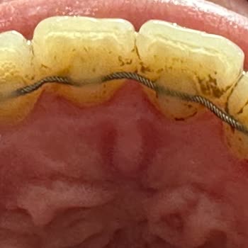 Redent Ağız ve Diş Sağlığı Polikliniği Diş Taşı Temizliği