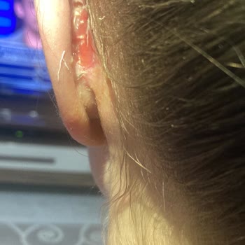 Op. Dr. Mehmet Sucubaşı Kepçe Kulak Ameliyatı