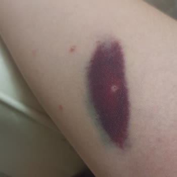 Avrasya Hospital Yanlış Damar Bulamama Kolum Daki Morluk Ve Ağrı