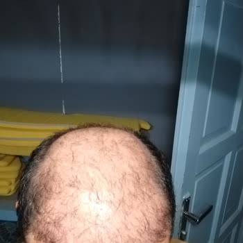 Ahmet Tektaş Hair Clinic Olumsuz Saç Ekimi