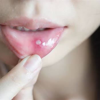 Sensodyne Diş Macunu Ağzımda Yaralara Sebep Oldu!