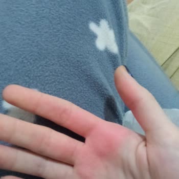 Altınkılıç Kefirin Patlaması Ve Elimin Şişmesi