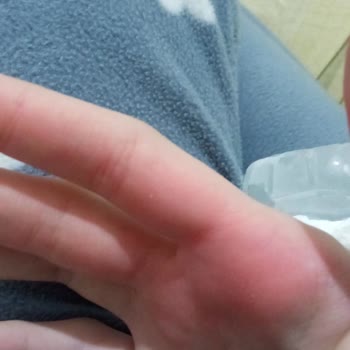 Altınkılıç Kefirin Patlaması Ve Elimin Şişmesi