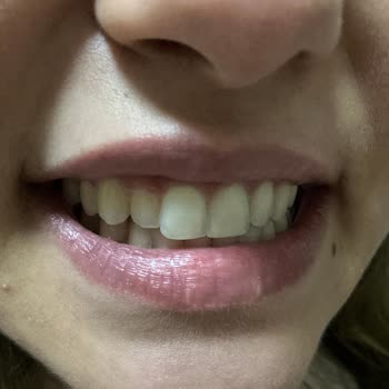 Dentaliva Diş Kliniği Dentaliva Plak Tedavisi