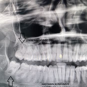 A Plus Dental (Kahramanmaraş) 20lik Diş Çekimi Komplikasyonu