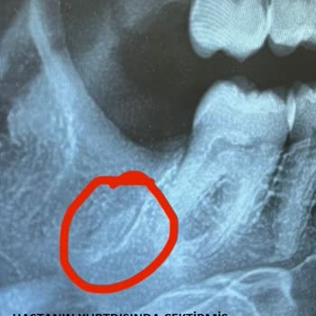 A Plus Dental (Kahramanmaraş) 20lik Diş Çekimi Komplikasyonu