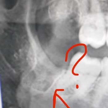 A Plus Dental (Kahramanmaraş) 20lik Diş Çekimi Komplikasyonu