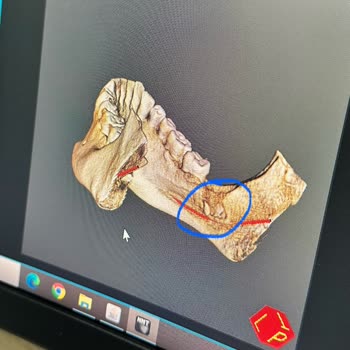 A Plus Dental (Kahramanmaraş) 20lik Diş Çekimi Komplikasyonu