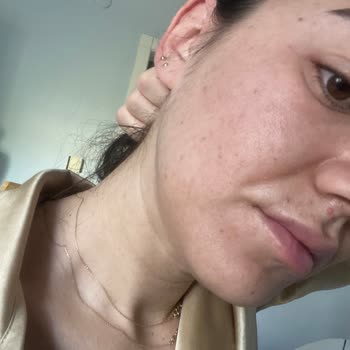 Kozvit La Roche Posta Yüzümde Yanma Yapıyor