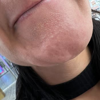 Formmed Polikliniği Cilt Bakımından Memnun Kalmadım. Söylediğimde Benimle Tartıştılar