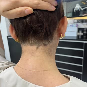 Nez Demir Lazerden Sonra Yüzümde Ensemde Yanıklardan Kaynaklı İzler Kaldı.