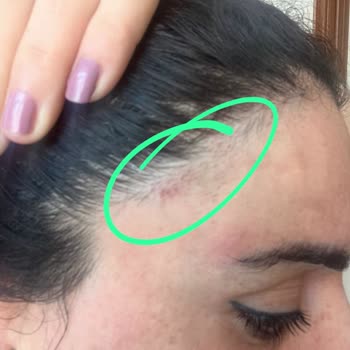 Nez Demir Lazerden Sonra Yüzümde Ensemde Yanıklardan Kaynaklı İzler Kaldı.