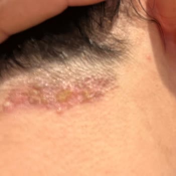 Nez Demir Lazerden Sonra Yüzümde Ensemde Yanıklardan Kaynaklı İzler Kaldı.