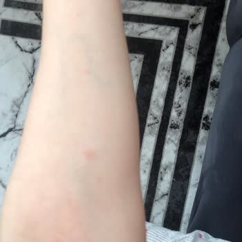 Viking Temizlik Genel Temizleme Ürünü Alerji Sorunu