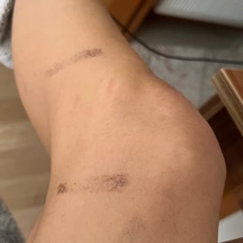 Hola Beauty (Ankara) Epilasyon Hizmeti Ve Müşteri Mağduriyeti Şikayeti