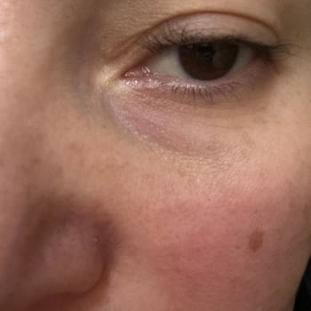 Nakkaş Med-Est Güzellik Merkezi Kirpik Lifting Yaptırmayın