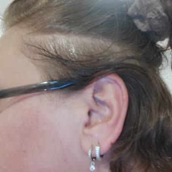 Dermokil Maske Yaktı Mahvetti Resmen