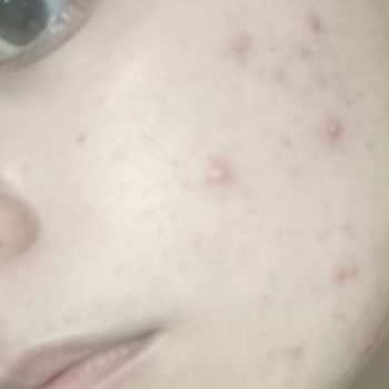 La Roche Posay Effaclar Duo Krem Şikayeti