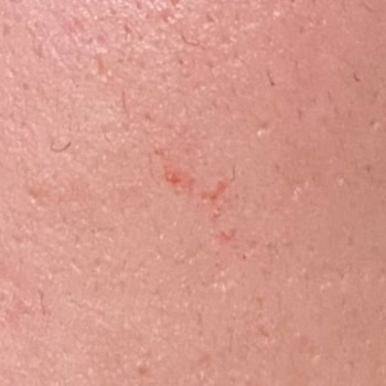 As Aksis Güzellik Salonu As Aksis Güzellik Merkezi Yüzüm Ve Cildim Yanıyor