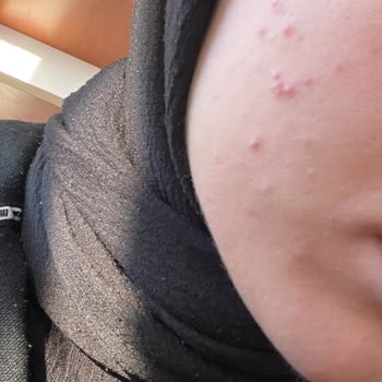 Doa Kozmetik Yüz Yıkama Jeli Cildimde Çok Sayıda Sivilceye Sebep Oldu