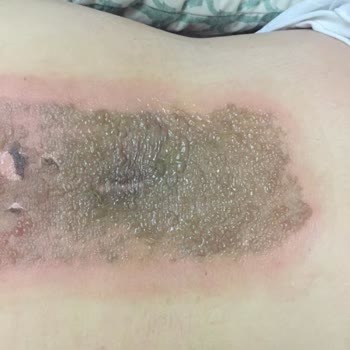 Artcure Yan Etkili Bandın Mağduru