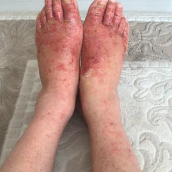 Artcure Yan Etkili Bandın Mağduru